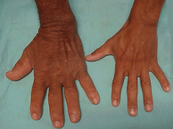 Рисование поможет оценить психическое состояние больных с акромегалией
