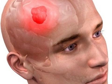 Ученые научились побеждать самый агрессивный вид рака