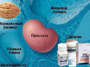Статины тормозят рак простаты